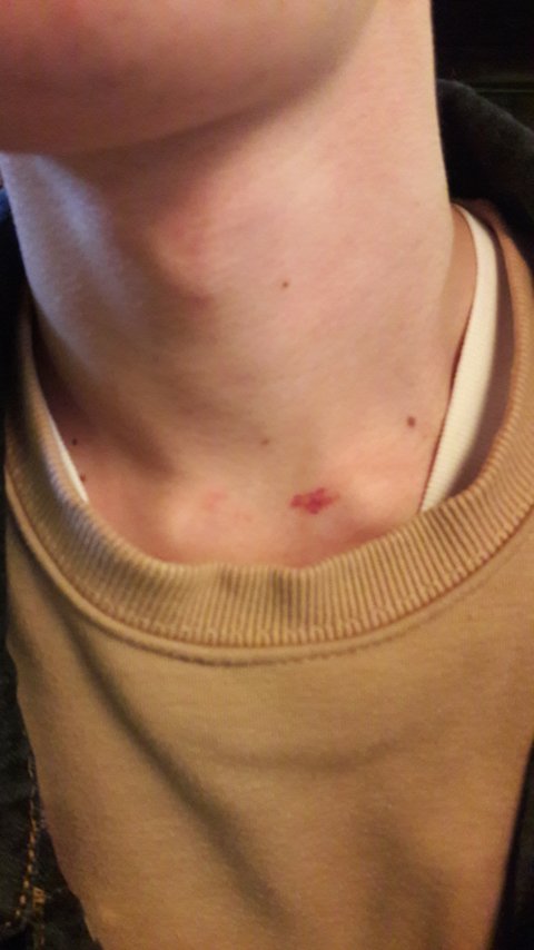 Looks hickey a rash that like strange rash