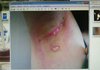 사진 有] 겨드랑이 제모 후 화상.. 