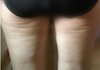 허벅지뒤쪽 울퉁불퉁 셀룰라이트 없앨 수 있을까요? 심각함ㅠ