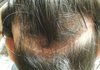 모발이식하고 인생 망쳤네요.... 부작용때문에..
