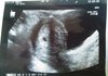(7주로 수정)임신 3주...ㅠㅠ(+초음파사진)