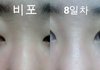 사진유)나 코수술 망한것 같아...?ㅠㅠ