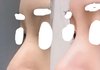 코수술 코끝내려옴 심하냐..