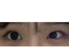 나 쌍수 + 눈매교정 개개개개개망한듯