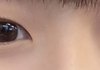(사진) 나 짝눈 교정해야 될까?ㅠ