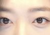 이런 눈 성형으로 안됨?