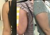 혐주의) 팔뚝 지흡 전후 볼래