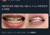 트위터에서 화제 중인 치아 미백 짤