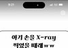 손 엑스레이 사진이 너무 무서움