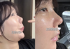 허안나, 코 재수술 고백 “이렇게 됐어요”[SNS는 지금]