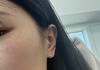 여드름약 (이소티논) 4개월 후기