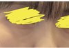 다크서클 너무 스트레스임