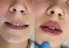 ㄹㅇ입술필러 개잘한다아님?