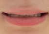 나 이거 교정 무조건 해야됨?ㅠㅠ