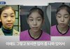 돌출입 교정으로 예뻐진 김연아