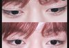 박지훈같은눈 성형으로가능함?