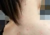 (여드름 사진 있음)내친구가 사람이면 이정도 등드름은 다 있다는데 맞아???