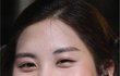 보톡스 맞은 '서현'얼굴
