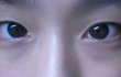 나 쌍수할까봐 어떤지봐죠 사진有