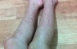 바디슬리밍제품 리*존 부작용 <사진있음>