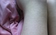 언니들 다리에 나있는 오돌톨한 빨간 두드러기? 이거 피부과가면없앨수있어?