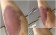 저희 엄마 손가락좀 봐주세요 !!!!ㅠㅠ