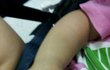  +수술후기+ <사진有>아이를 아프게 해 놓고 오리발 내미는 병원
