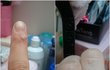 피부과에서 억울한 일을 당해었어요 ㅠㅠ 사마귀사진있으니 사진주의