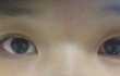 사진有)방금쌍커풀수술하고왔는데 봐주세요