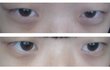 (혐) 앞트임 VS 지방재배치