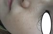 사진有有 피부 좀 봐주세요 ㅠㅠ 이거 좁쌀여드름 인가요??