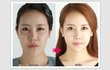 페이스라인 전후사진