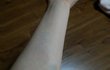 헌혈후 나의 팔뚝은 불쌍했다....(사진 있음)