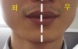 제 비대칭 턱 좀 봐주세요.