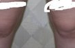 예시 사진有) 최악의 코끼리다리.아톰다리.다리살을 어떻게 빼야할까요..ㅠㅠ