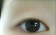 쌍수해야할까요...ㅠㅠ