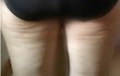 허벅지뒤쪽 울퉁불퉁 셀룰라이트 없앨 수 있을까요? 심각함ㅠ