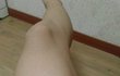 다리가 움푹해요