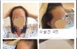 넓은이마에서 좁은이마로 헤어라인 모발이식 후기