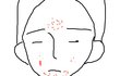 여드름 때문에 스트레스 받아요 도와주세요ㅠㅠ