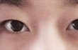 쌍수 + 트임 할까요?
