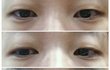 쌍수 할까 말까너무 고민돼요 (사진있음)
