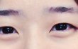 쌍수 전후 ㅠㅠ 도와줘요