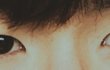 안검하수 질문