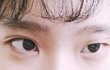 저 심한 짝눈인데 쌍수 해야할까요?