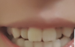 내덧니 매력잇지않음?