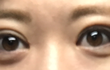 쌍수 후기 ( 짝눈 심함ㅠ )