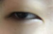 약혐)오늘 쌍수했는데 붓기가 진심 너무심해..ㅜㅜㅜ