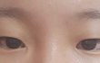 쌍수랑 앞트임