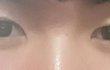 남자 눈교+쌍수 1년차 평가좀